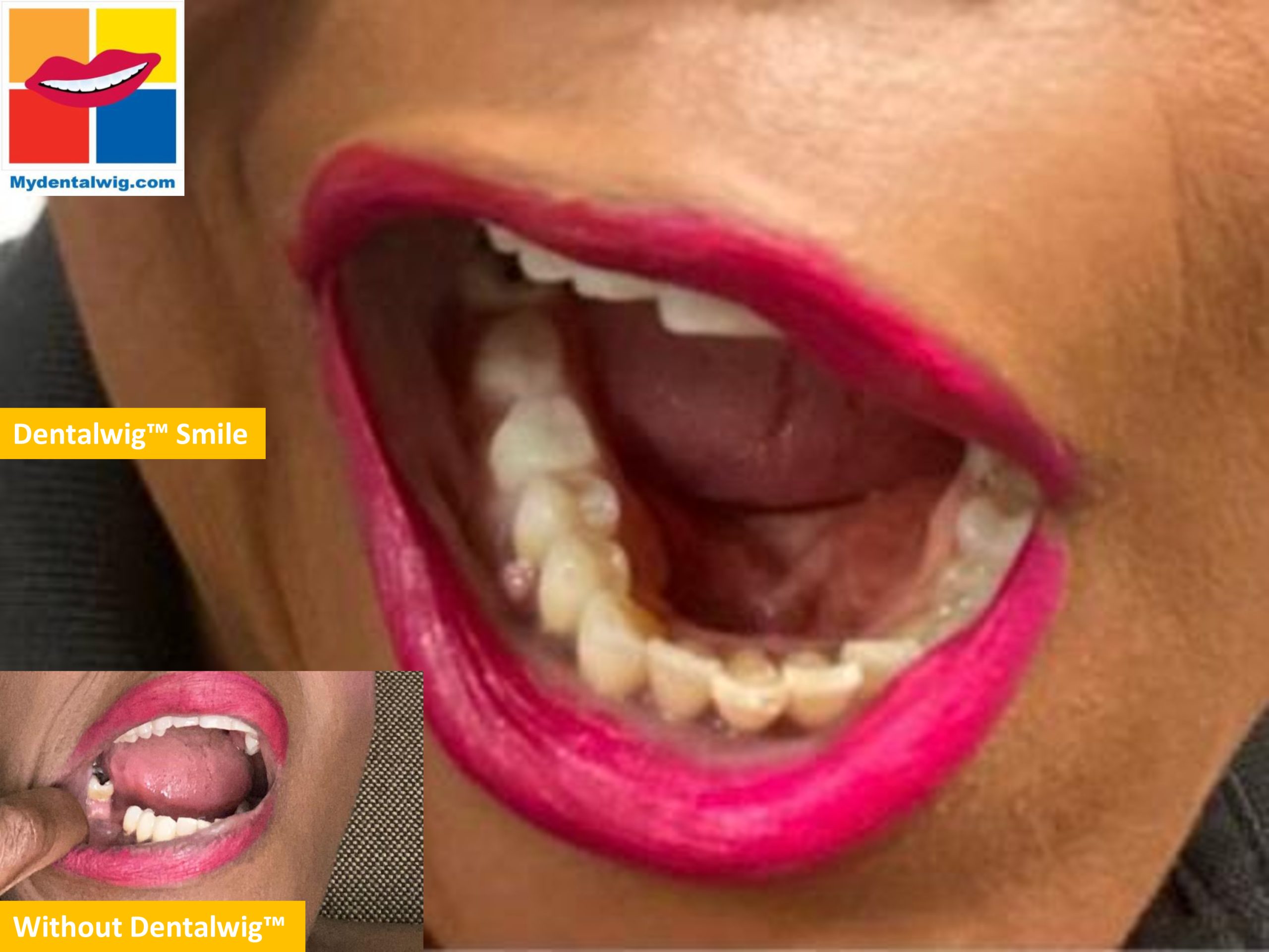 Lydie Livolsi CEO & Founder Of MYDENTALWIG Wearing Her Dentalwig Here On Her Lower Jaw